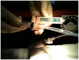 Nursing CPG Replogle Suction Lumen Nursing CPG Replogle Suction Lumen